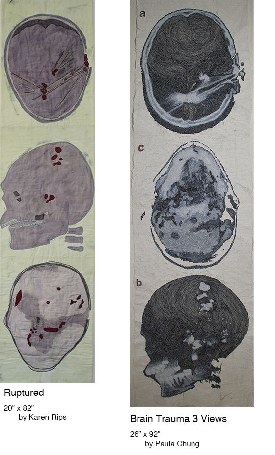 Ruptured/Brain Trauma 3 Views